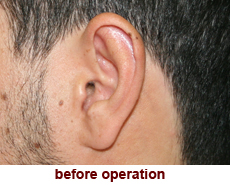 plastic-surgery-prominent-ear 